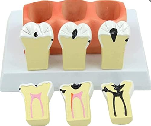 מודל הוראה, עששת שיניים מפורקת מודל אנטומי דגם שיניים סטנדרטי -Kids לימוד שיניים לימוד שיניים