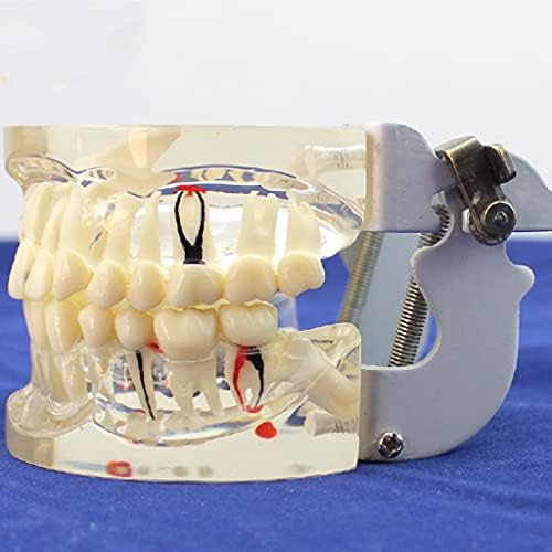 Kh66zky שיניים שתל מחלת שיניים מודל שקוף למבוגר מקיף פתולוגיה פתולוגית אוראלית כלי הוראה צעצוע סטודנטים לימוד