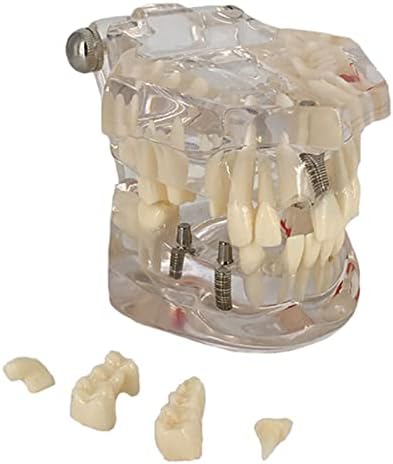 דגם שיני שיניים של שיניים שיניים של סוזלה דגם שיני שיניים עבור רופא שיניים למידת סטודנטים, הוראה, תקשורת מחקרית