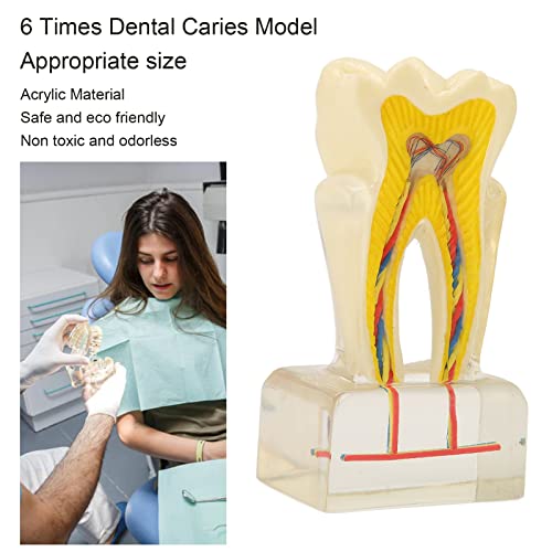 שיניים עששת דגם, שן צלב סעיף תצוגת דגם, רקוב שן דגם, אוראלי טיפול חינוך אספקת עבור רופאי שיניים
