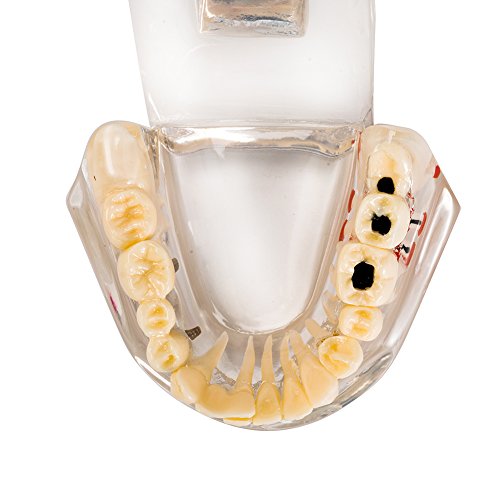 דגם שיניים של שתל שיניים של Easyinsmile מודל שיניים