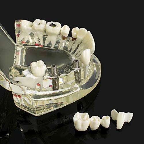 דגם שיניים סטנדרטי שיניים שיניים מחלות שיניים שיניים שיניים שיקום עם השתל להפגנה